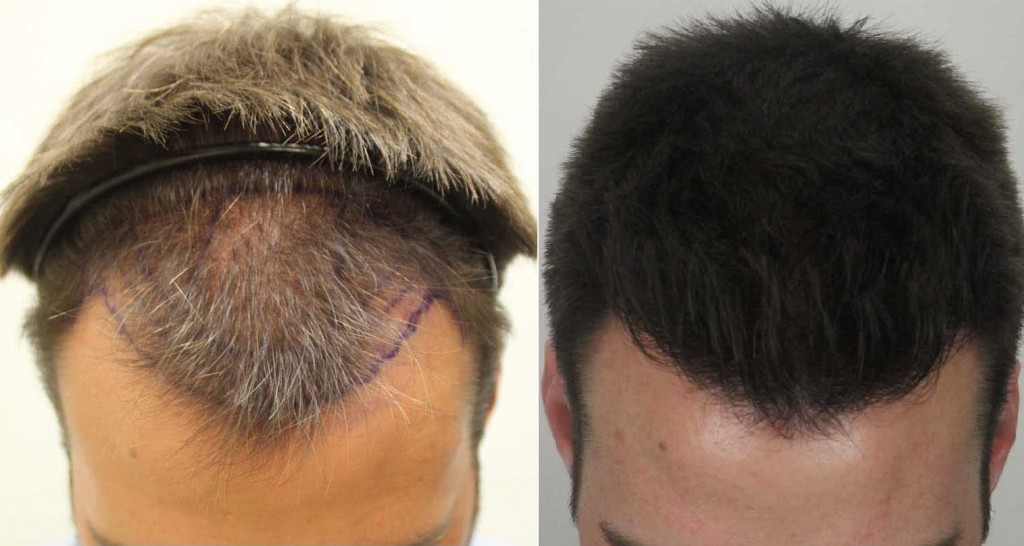 regrow hair with laser